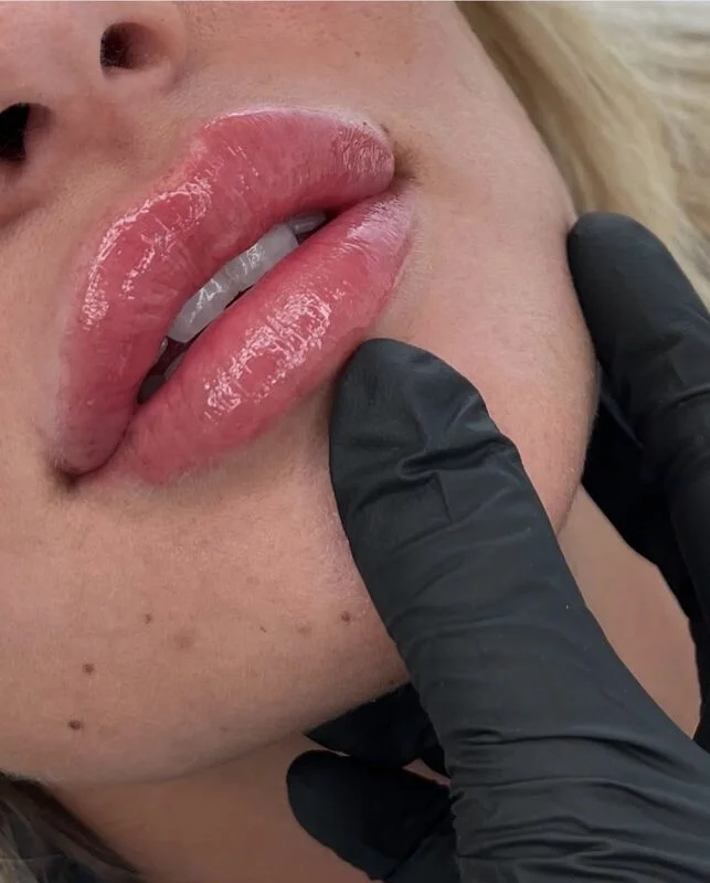 Aesthetic treatments and injectables in Birstall, Leicester