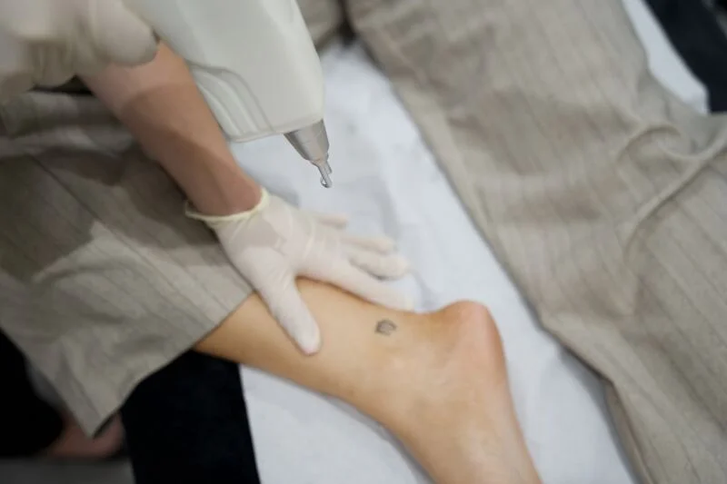 Laser tattoo removal in Birstall, Leicester
